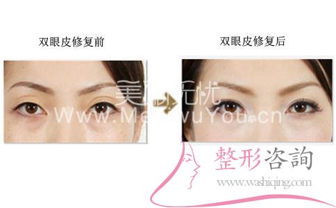 <a href=http://m.f3bb6.cn/listinfo-724-0.html target=_blank class=infotextkey>雙眼皮</a>修復