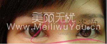 割開法<a href=http://m.f3bb6.cn/listinfo-724-0.html target=_blank class=infotextkey>雙眼皮</a>