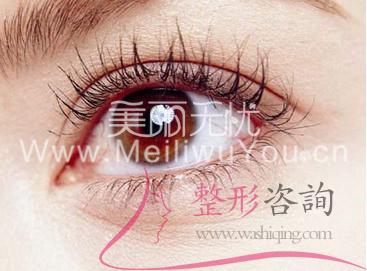 <a href=http://m.f3bb6.cn/listinfo-724-0.html target=_blank class=infotextkey>雙眼皮</a>手術 <a href=http://m.f3bb6.cn/listinfo-724-0.html target=_blank class=infotextkey>雙眼皮</a>手術