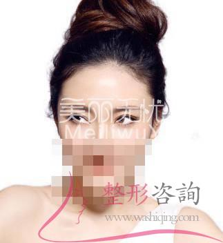 割<a href=http://m.f3bb6.cn/listinfo-724-0.html target=_blank class=infotextkey>雙眼皮</a>