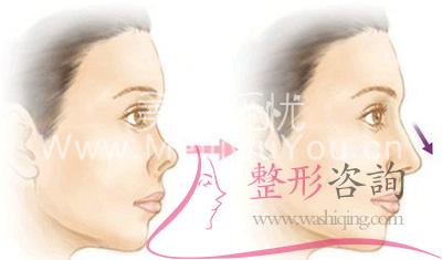 <a href=http://m.f3bb6.cn/listinfo-758-0.html target=_blank class=infotextkey>朝天鼻矯正</a>術(shù) <a href=http://m.f3bb6.cn/listinfo-758-0.html target=_blank class=infotextkey>朝天鼻矯正</a>術(shù)