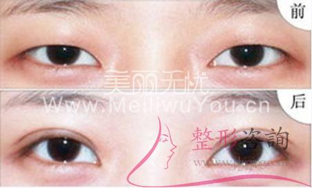 <a href=http://m.f3bb6.cn/listinfo-724-0.html target=_blank class=infotextkey>雙眼皮</a> <a href=http://m.f3bb6.cn/listinfo-724-0.html target=_blank class=infotextkey>雙眼皮</a>