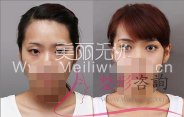 割<a href=http://m.f3bb6.cn/listinfo-724-0.html target=_blank class=infotextkey>雙眼皮</a>失敗 <a href=http://m.f3bb6.cn/listinfo-724-0.html target=_blank class=infotextkey>雙眼皮</a>修復需立刻