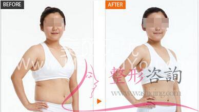 腹部<a href=http://m.f3bb6.cn/listinfo-685-0.html target=_blank class=infotextkey>吸脂</a>術 腹部<a href=http://m.f3bb6.cn/listinfo-685-0.html target=_blank class=infotextkey>吸脂</a>術