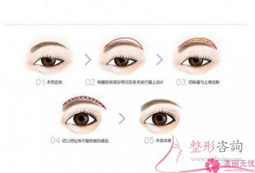 一次皮秒激光<a href=http://m.f3bb6.cn/listinfo-658-0.html target=_blank class=infotextkey>洗眉</a>能夠清潔凈紋眉嗎