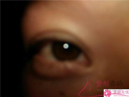 埋線<a href=http://m.f3bb6.cn/listinfo-724-0.html target=_blank class=infotextkey>雙眼皮</a>能夠保持好久，術后效果如何