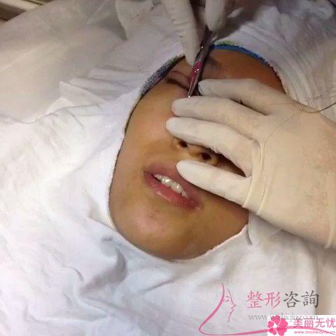 埋線<a href=http://m.f3bb6.cn/listinfo-724-0.html target=_blank class=infotextkey>雙眼皮</a>能夠保持好久，術后效果如何