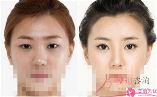 開內眼角后應該怎么護理比較好？留下線頭如何是好？