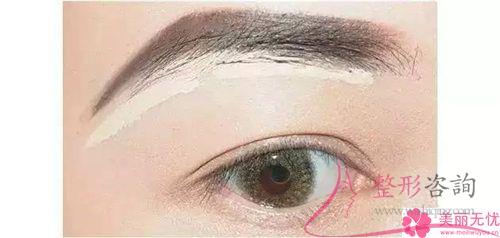 這4類種植眉毛的長處朋友們了解嗎
