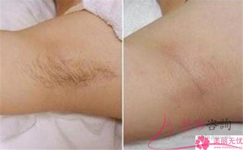 進(jìn)行一次冰點(diǎn)永久<a href=http://m.f3bb6.cn/listinfo-670-0.html target=_blank class=infotextkey>脫毛</a>花費(fèi)要多少