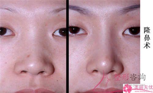 假體硅膠<a href=http://m.f3bb6.cn/listinfo-737-0.html target=_blank class=infotextkey>隆鼻</a>成效能維持好久?得住院?jiǎn)幔? /></p><p>挺立的鼻子能提高1個(gè)女性的整體形象,所以一些鼻梁低平的妹紙們想實(shí)施硅膠<strong><a href=http://m.f3bb6.cn/listinfo-737-0.html target=_blank class=infotextkey>隆鼻</a>整形</strong>術(shù)來(lái)完成立體感,硅膠<a href=http://m.f3bb6.cn/listinfo-737-0.html target=_blank class=infotextkey>隆鼻</a>整形術(shù)是一個(gè)現(xiàn)代化的醫(yī)療水平,術(shù)后結(jié)果更天然,可是之后維持時(shí)間是一有必要關(guān)心的難題。那麼,如何加強(qiáng)硅膠<a href=http://m.f3bb6.cn/listinfo-737-0.html target=_blank class=infotextkey>隆鼻</a>后的保養(yǎng)技巧?</p><p style=