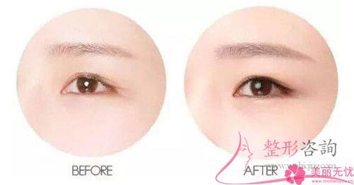 到底怎么樣選取解決掉川字紋的方法，美眉們想問嗎