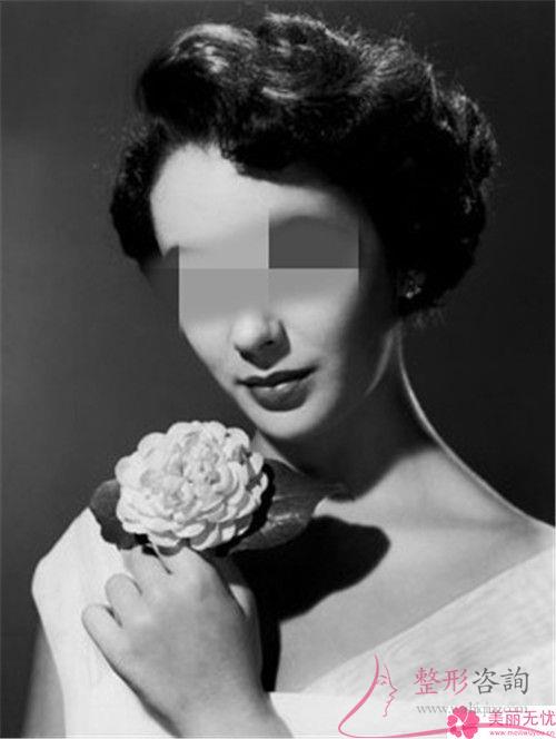 電波拉皮術后就能夠效果展現嗎?面部有些什么轉變呢