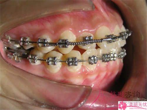 牙齦切除對牙齒有沒有害處