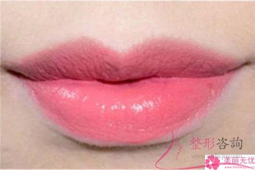 唇外翻幾歲矯正合適