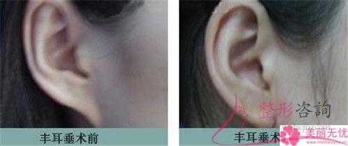 小孩子隱耳怎么治療傷害最小