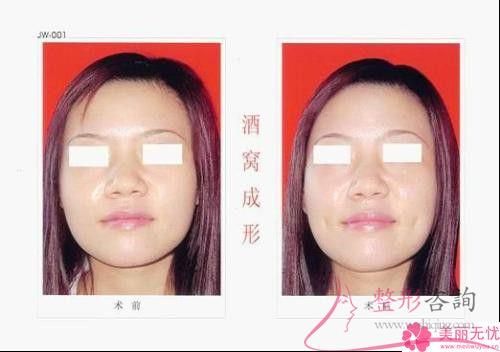 酒窩成形有幾種類型