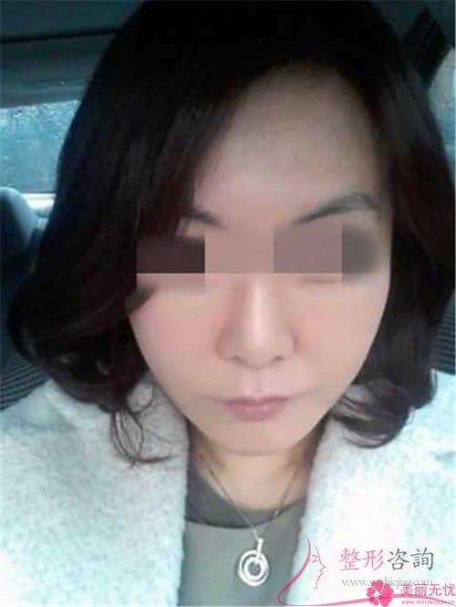 具體哪種填充<a href=http://m.f3bb6.cn/listinfo-614-0.html target=_blank class=infotextkey>除皺</a>措施適用于32歲的小伙伴們