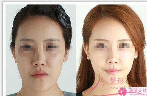 削骨<a href=http://m.f3bb6.cn/listinfo-631-0.html target=_blank class=infotextkey>瘦臉</a>術(shù)得注意什么