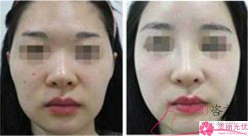 去整形美容機構做激光去痣貴不？多少元錢一顆