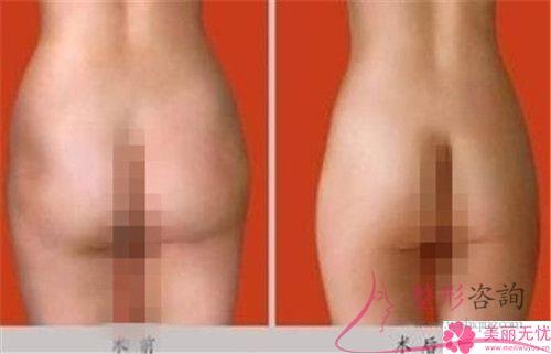 哪些人群能夠接受自體<a href=http://m.f3bb6.cn/listinfo-677-0.html target=_blank class=infotextkey>豐臀</a>