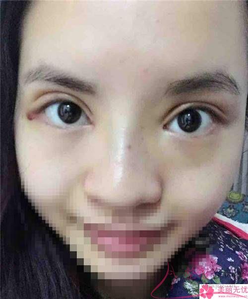 外眥開大術會不會重返先前的模樣？