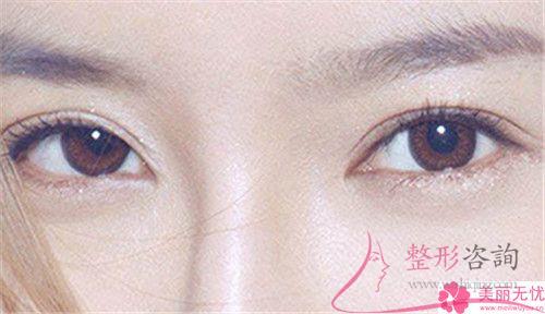 成都實(shí)施無(wú)痕<a href=http://m.f3bb6.cn/listinfo-711-0.html target=_blank class=infotextkey>開眼角</a>術(shù)花多少錢？貴么