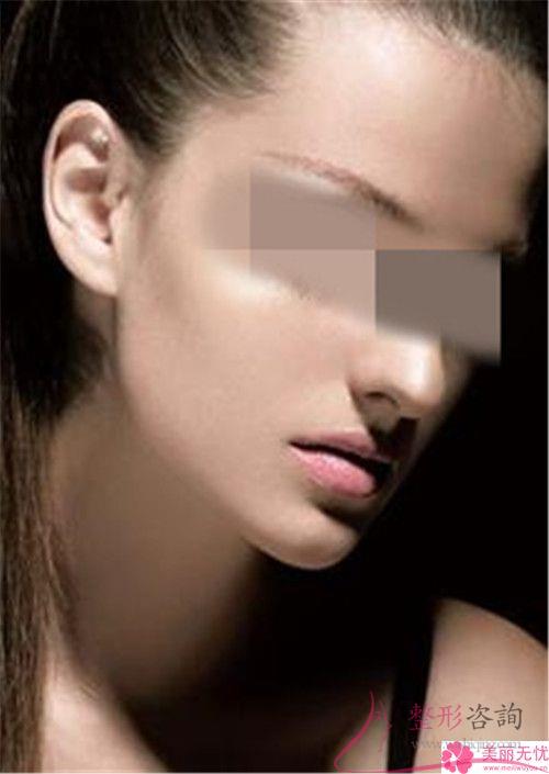 手術方法進行面部提拉的價格