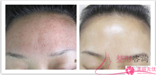 紅光與藍(lán)光祛痘存在一些什么優(yōu)點(diǎn)