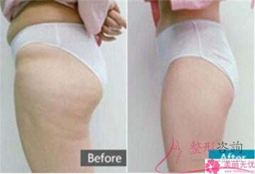 自體組織<a href=http://m.f3bb6.cn/listinfo-677-0.html target=_blank class=infotextkey>豐臀</a>的四個優點