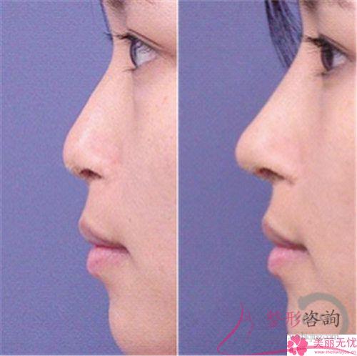 蒜狀鼻整形美容完成之后外形出入是不是非常鮮明
