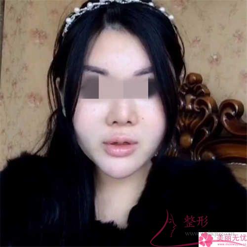 鋸齒線懸掛緊致去皺術到底有哪些具體的功能