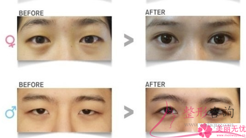 韓式<a href=http://m.f3bb6.cn/listinfo-724-0.html target=_blank class=infotextkey>雙眼皮</a>手術有什么技巧
