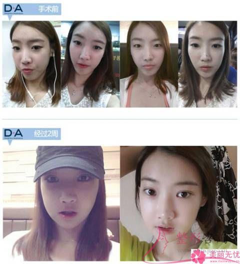 鼻頭整形手術原材料分別有什么