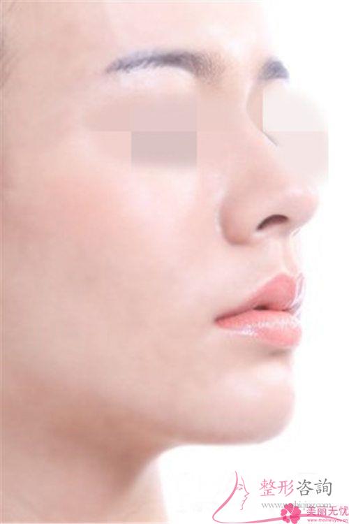 鼻部去皺18884足夠嗎