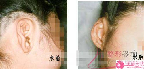 傷口沾水后不利于自體脂肪<a href=http://m.f3bb6.cn/listinfo-694-0.html target=_blank class=infotextkey>豐耳垂</a>后的恢復(fù)嗎