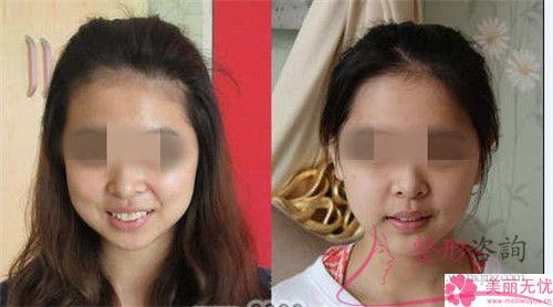 面部填充整形有統(tǒng)一收費標準嗎