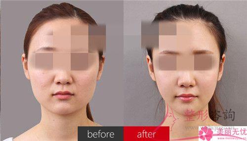 面部填充整形有統(tǒng)一收費標準嗎