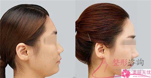 面部填充整形有統(tǒng)一收費標準嗎