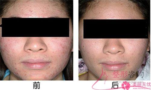 激光去痘痕大概的費(fèi)用是多少