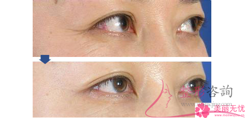 眼瞼外翻治療屬于整形類別嗎