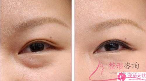 眼瞼外翻治療屬于整形類別嗎