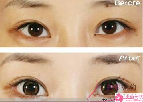 眼瞼外翻治療屬于整形類別嗎