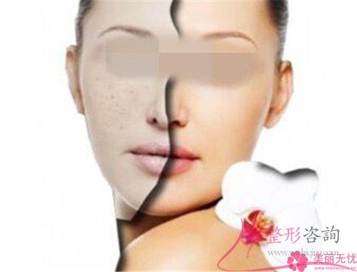 <a href=http://m.f3bb6.cn/listinfo-795-0.html target=_blank class=infotextkey>祛斑</a>大約費(fèi)用