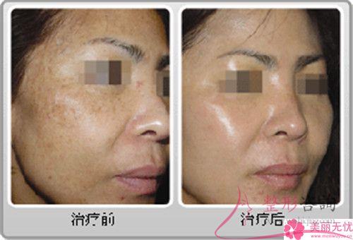 <a href=http://m.f3bb6.cn/listinfo-795-0.html target=_blank class=infotextkey>祛斑</a>大約費(fèi)用