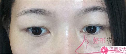 超聲法<a href=http://m.f3bb6.cn/listinfo-708-0.html target=_blank class=infotextkey>去眼袋</a>多久可以恢復(fù)好