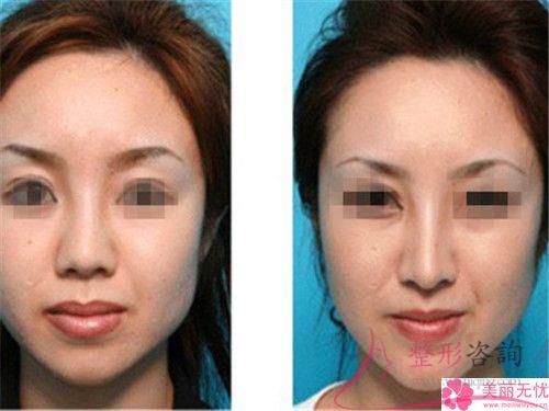 注入奧美定<a href=http://m.f3bb6.cn/listinfo-737-0.html target=_blank class=infotextkey>隆鼻</a>的常見注意事項有哪些