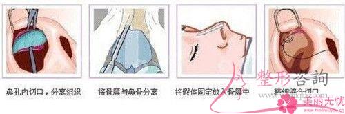 注射微晶瓷<a href=http://m.f3bb6.cn/listinfo-737-0.html target=_blank class=infotextkey>隆鼻</a>的常見注意事項具體有哪些