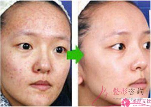 美萊激光祛痘該怎樣打理？結(jié)果如何？