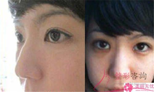 蒜頭鼻醫(yī)療美容結(jié)束以后跟沒有進行之前差別會不會比較顯目